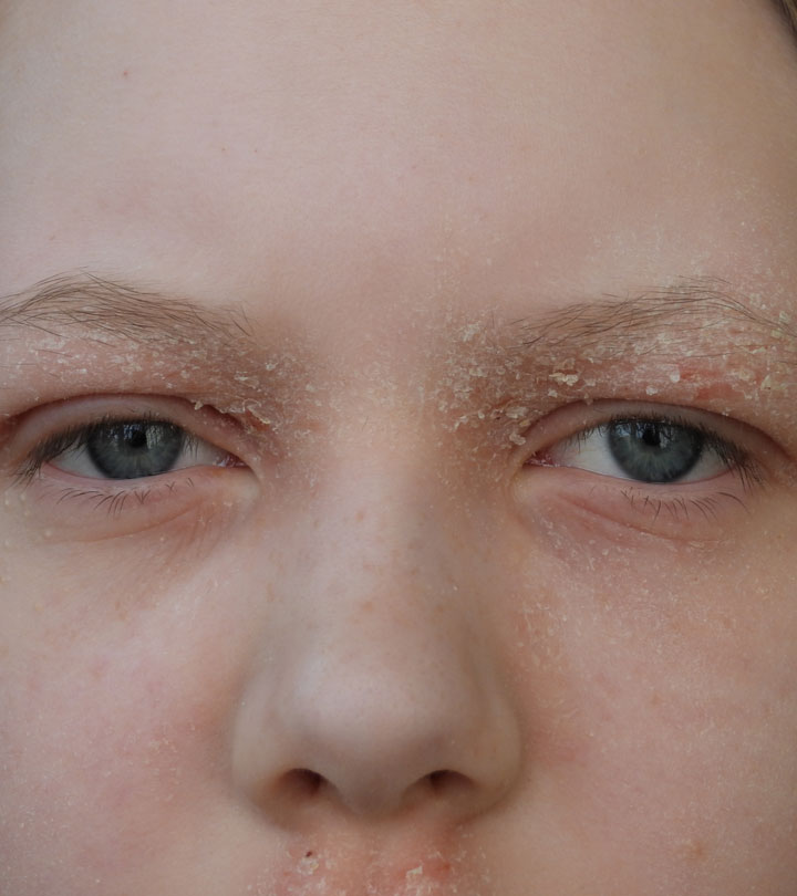 Dry Eyelids: Causes, Symptoms, And Treatment