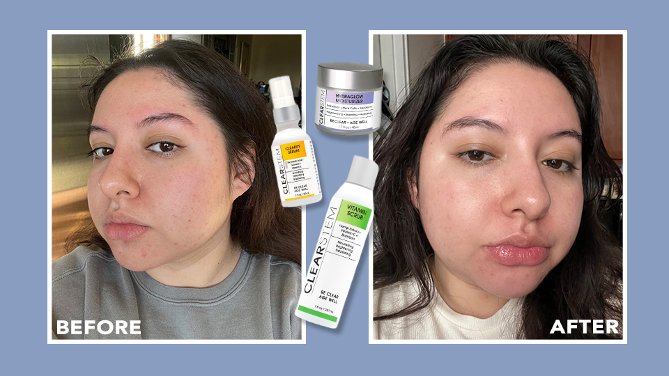 An Honest Review of Clearstem’s Anti-Aging and Acne Products